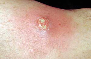 skin boil