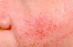 Rosacea Treatment Is Possible!