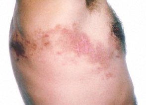 Chicken Pox Virus Can Cause Shingles!