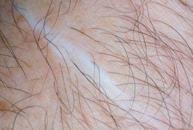 White Patches On Your Skin? It Can Be Vitiligo!