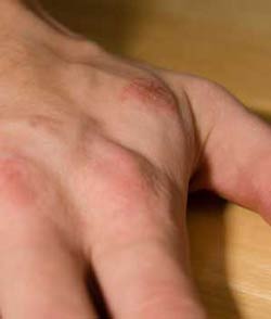Useful Information On Eczema Treatment!