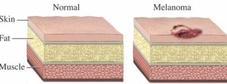 Melanoma