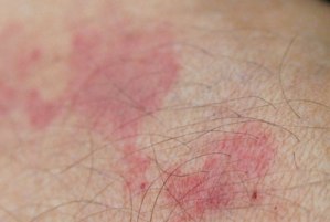 Is Your Eczema Making Severe Irritation? Find The Eczema Cause In Order To Have Proper Treatment!