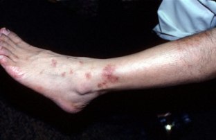 Avoid Potential Triggers Of Inflammation To Stay Away From Contact Dermatitis!