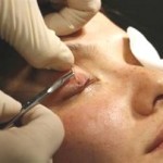 What Is Eyelash Transplant Surgery And How Is It Useful?