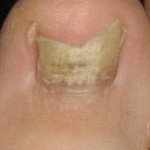 Treating Nail Fungus With Alternative Remedies