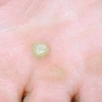 How Human Papilloma Virus Warts Spread?