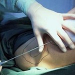 Liposuction: Side Effects And Possible Complications