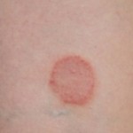 How To Treat Shingles Rash At Home?