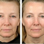 Can Thermage Be The New Step In Beauty Surgery?