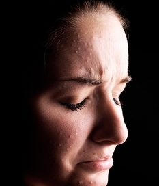 Adult Acne