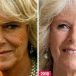 Bee Venom – The New Botox?