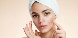 10 Common Acne Myths and Facts