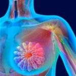 Breast Cancer Surgery