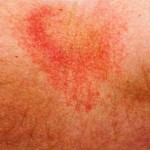 Eczema Skin Condition