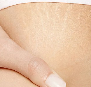 White Stretch Marks