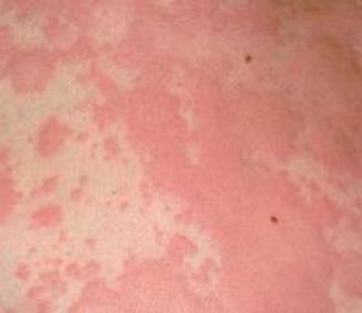 Cause of hives Cause of hives