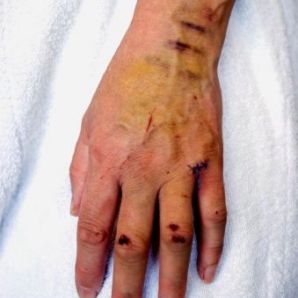 Skin Discoloration Treatment