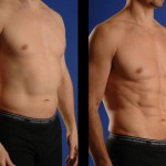 Laser Liposuction