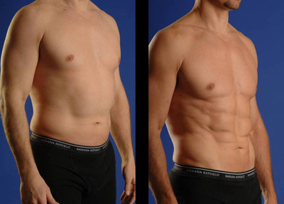 Laser Liposuction