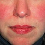 Rosacea