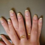 Nail Psoriasis