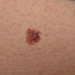 Melanoma