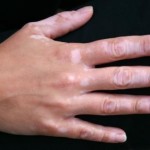 Vitiligo