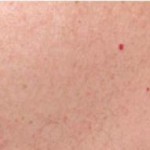 Small Red Spots on Skin