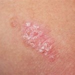 What is Psoriasis Symptoms?