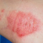 How to Treat Eczema Naturally