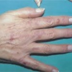 Symptoms of Porphyria Cutanea Tarda
