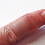 What is psoriatic arthritis treatment