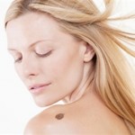 radiation treatment for melanoma skin cancer