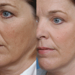 Get a Fresh Start with Laser Skin Resurfacing