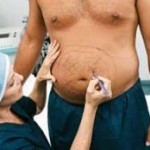 What’s this – Abdominoplasty or Tummy Tuck?