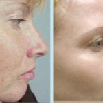 Photorejuvenation Procedure Could Help Correct Skin Irregularities