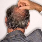 Alopcecia-areata-treatment