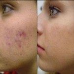 Best Dark Spots on Face Treatment