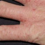 Evaluating Different Types of Eczema Skin Conditions