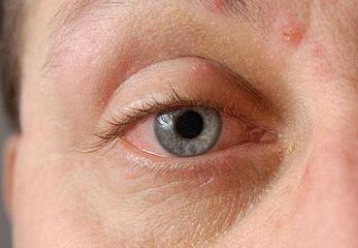 How Do You Get Shingles in the Eye