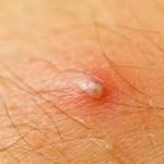 How to Prevent and Get Rid of Ingrown Hairs?