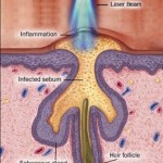 Laser-Treatment-for-Acne