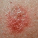 Skin Cancer: Exposure to Sunlight Determines the Type of Cancer Caused