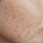 How Important Is Your Skin Pigmentation?