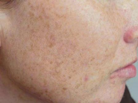 Skin Pigmentation