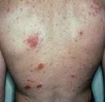 Susceptibility Loci for Eczema Paves Way for New Treatments