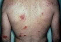 Susceptibility Loci for Eczema Paves Way for New Treatments