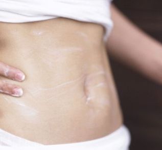 stretch-mark-treatment