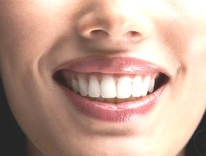teeth-whitening-prices